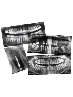 Zubné röntgeny