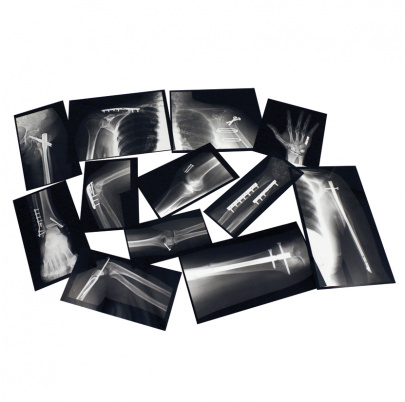 RTG snímky napravených zlomenín kostí